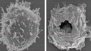 ホジキンリンパ腫に対するアナポコーシス抗体投与前（左）と投与30分後の電子顕微鏡写真。生じる穴の大きさは、補体やパーフォリンなどによって開く穴の200倍にも達する